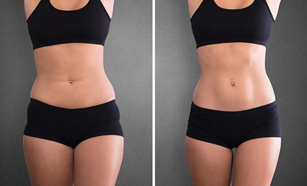 Is Body Contouring Right for You?