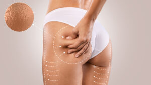 Sculpt Your Dream Body with Venus Bliss at Rose Beauty Clinic